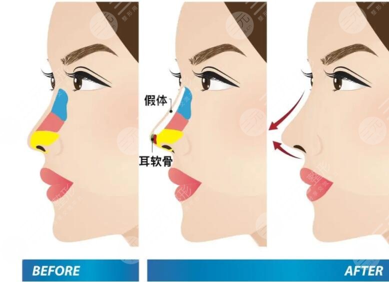 上海薇琳医疗美容医院做鼻子好不好