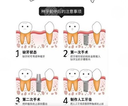 上海种植牙多少钱一颗