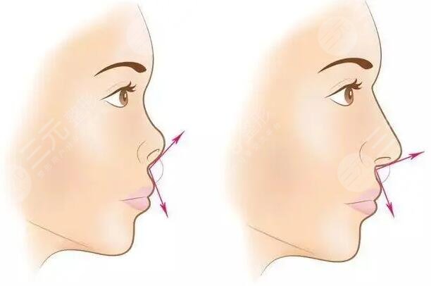  How about nose augmentation in Shanghai Huashan Hospital