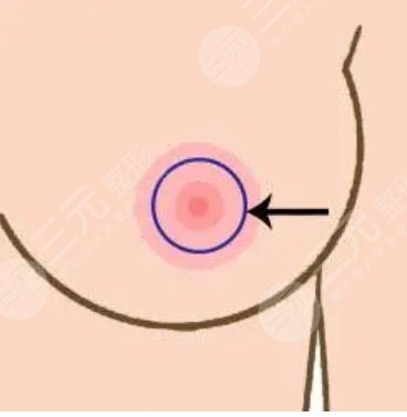  Which doctor is better for reducing areola in plastic surgery department of Zhejiang Traditional Chinese Medicine Hospital