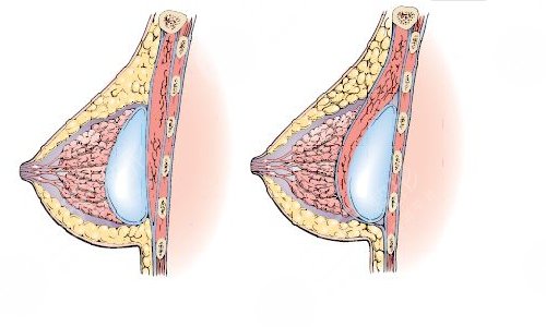  How much is the breast augmentation of Chengdu Hengbo Tianzi