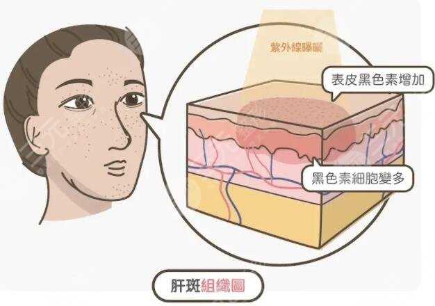 快速祛斑小窍门有哪些