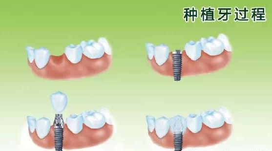 301医院口腔科种牙怎么样