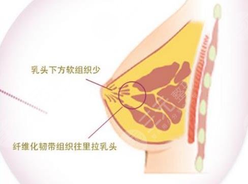 大連微美整形醫(yī)院做的隆胸一下?lián)碛衏罩