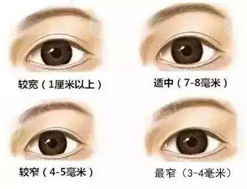 重庆附一院双眼皮手术费用更新