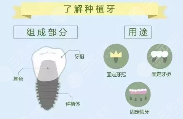 广州广大口腔医院种植牙如何