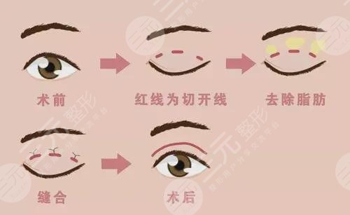  How about doing double eyelid surgery in Liwan District People's Hospital