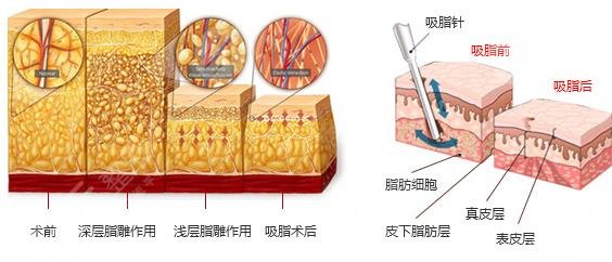 荔灣區(qū)人民醫(yī)院吸脂多少錢